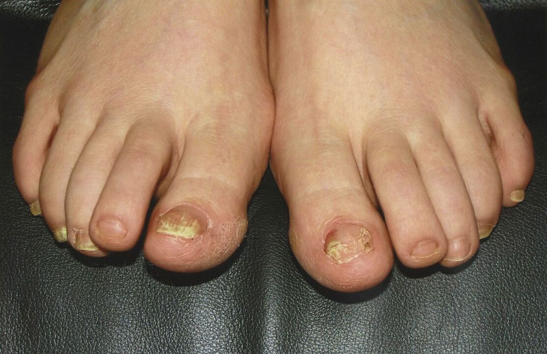 nola tratatu oinetako onddoak iltze esmaltearekin